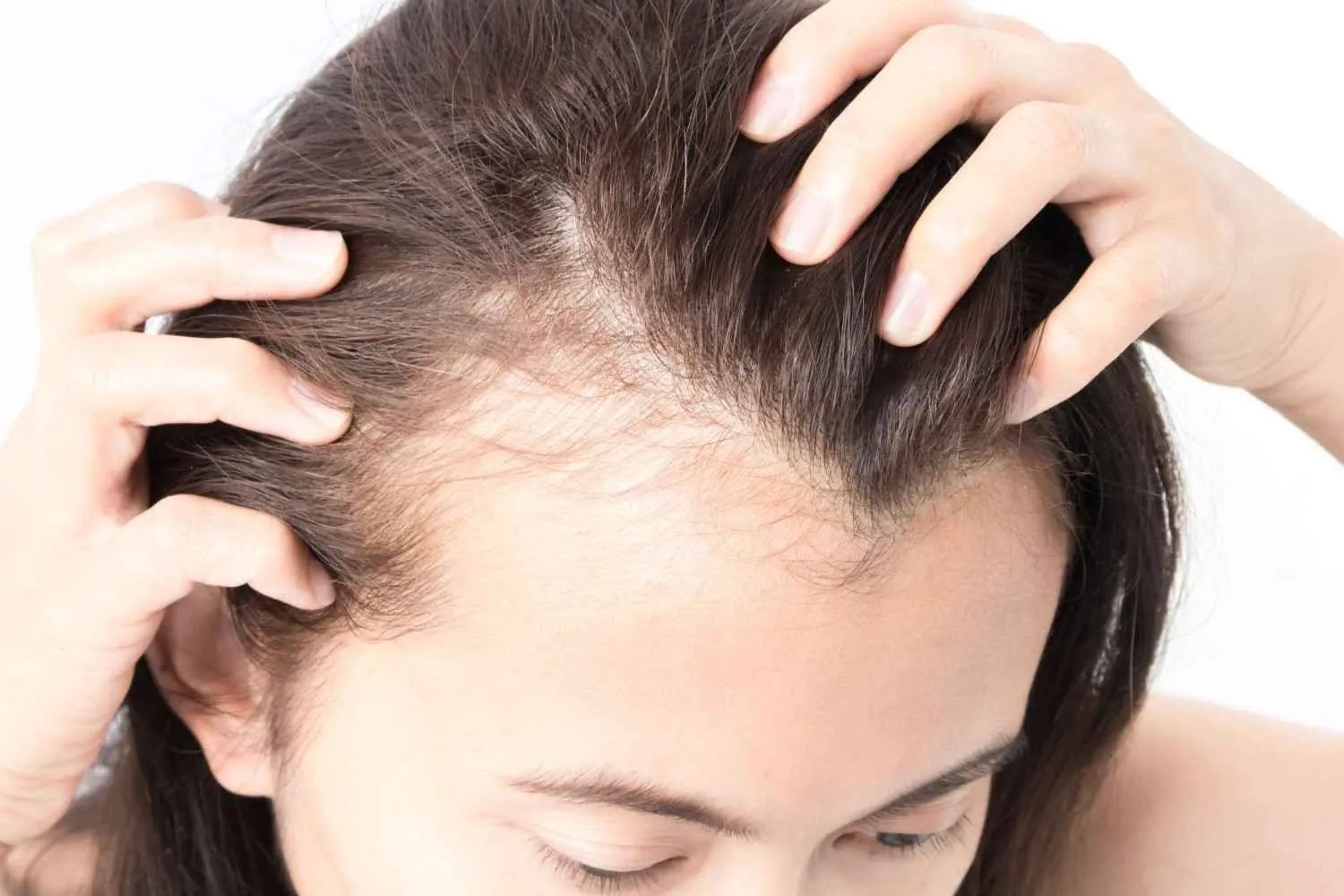 hair transplant