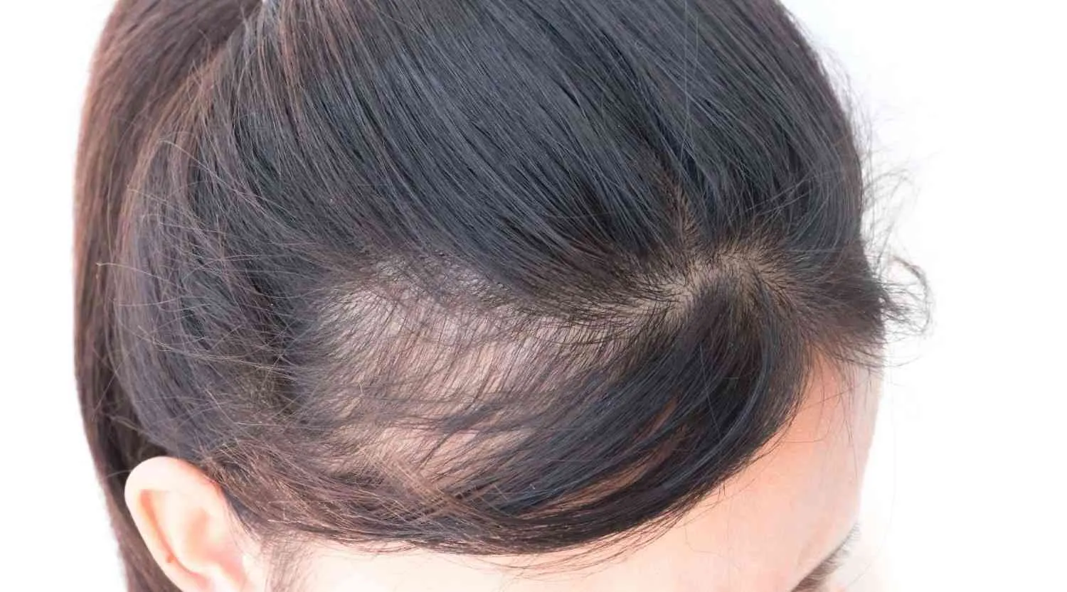 hair transplant