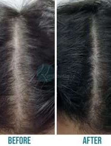 Before & After Of Hair Transplant