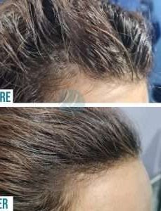 Before & After Of Hair Transplant